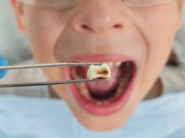 Best Emergency Root Canal Treatment in Dover Base Housing, DE